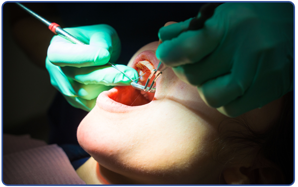 Tooth Extractions