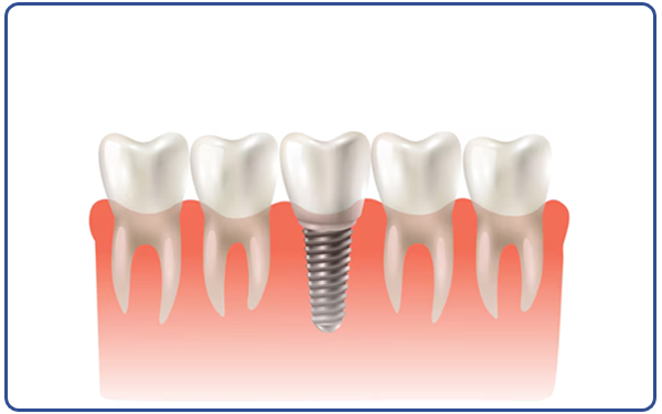 Single Tooth Implant