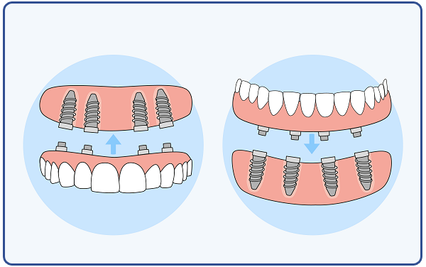 All on 4 Implant