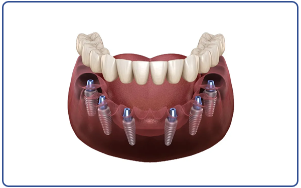 All on 6 or 8 Implant