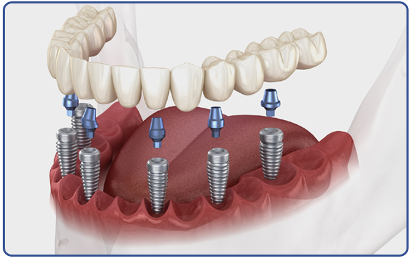 Basal Implants