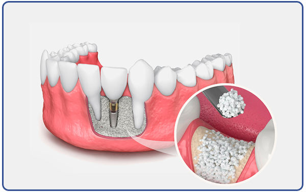 Bone Grafting