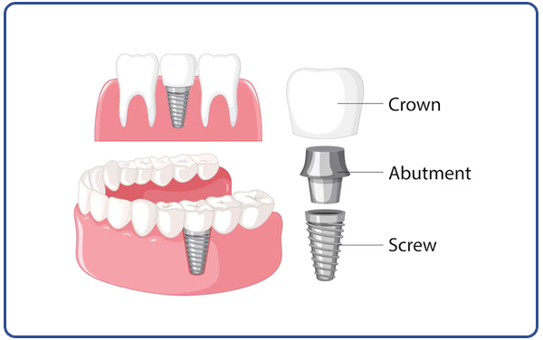 Same Day Implant