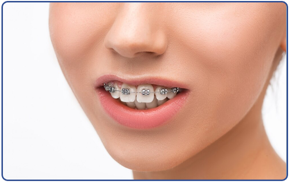 Orthodontic Treatments